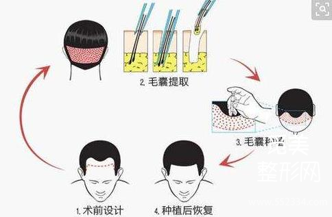 成都雍和植发正规吗?哪个医生做得好?费用大概是多少?
