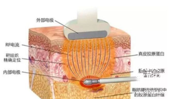 深度解析黄金微雕作用、适合部位和价格,和传统吸脂相比到底谁更好?