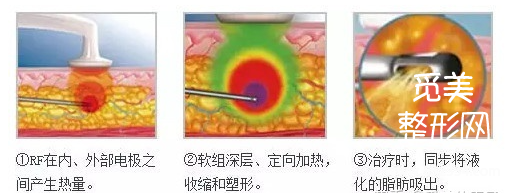 深度解析黄金微雕作用、适合部位和价格，和传统吸脂相比到底谁更好？