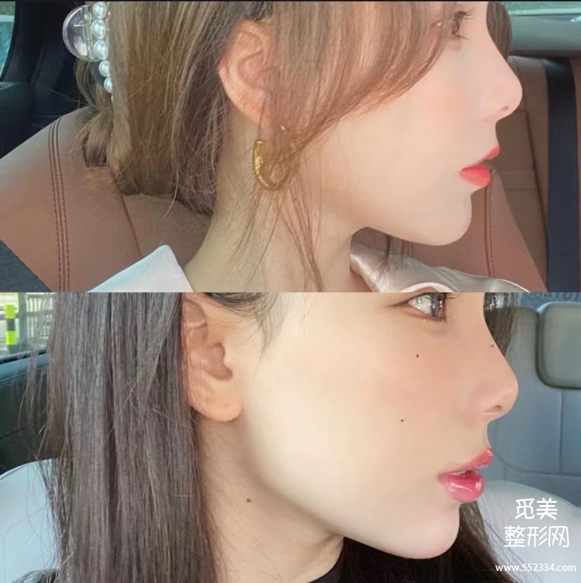 深度解析黄金微雕作用、适合部位和价格,和传统吸脂相比到底谁更好?