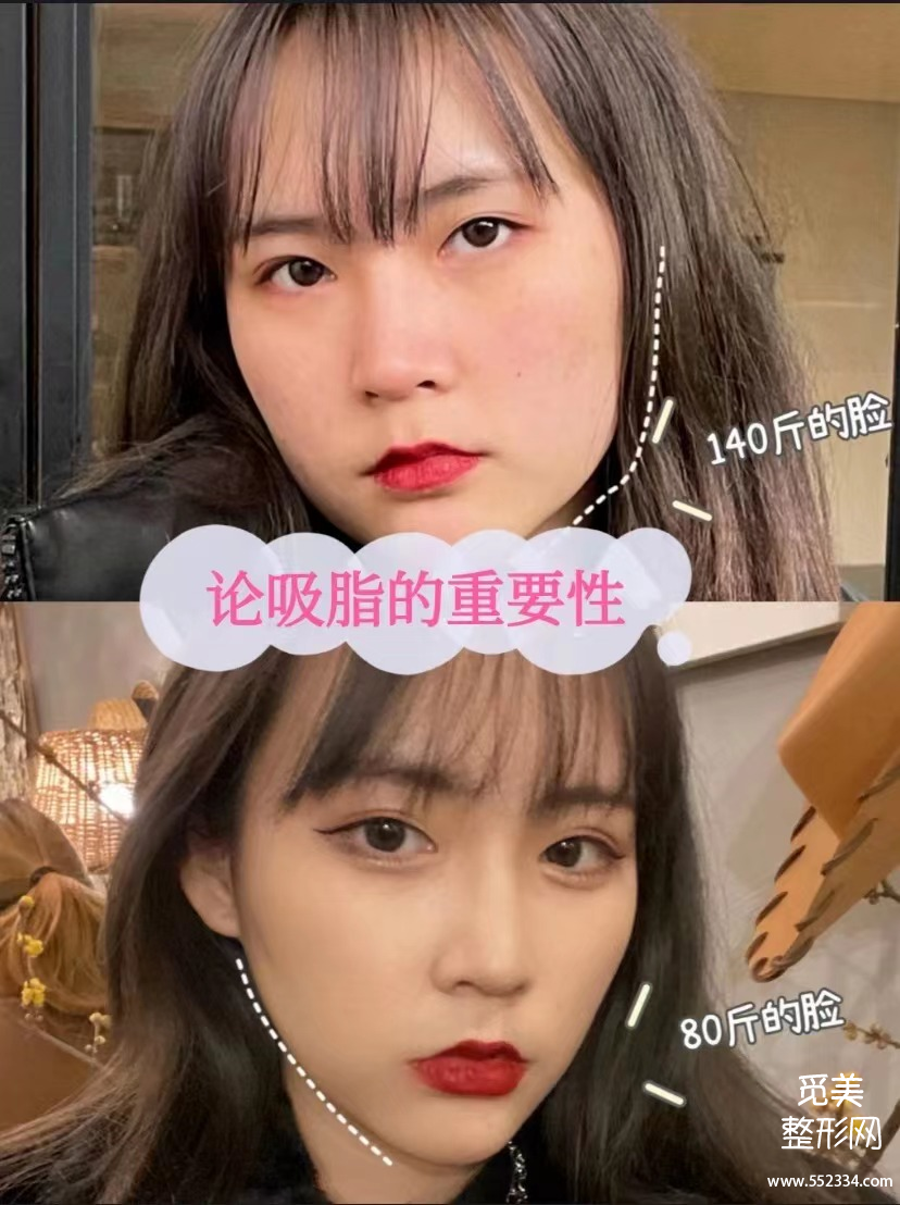 深度解析黄金微雕作用、适合部位和价格,和传统吸脂相比到底谁更好?