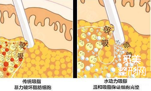 深度解析黄金微雕作用、适合部位和价格,和传统吸脂相比到底谁更好?