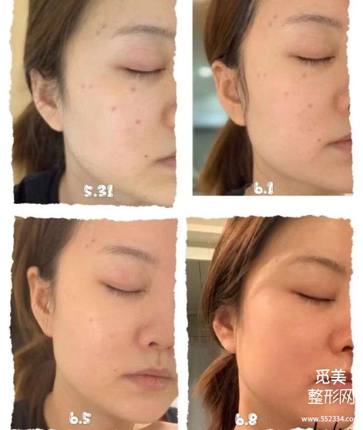 祛黄褐斑的方法*全解答!有黄褐斑困扰的姐妹进来看!