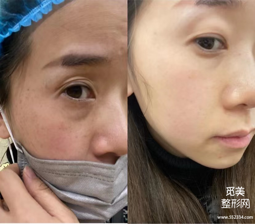 祛黄褐斑的方法*全解答!有黄褐斑困扰的姐妹进来看!