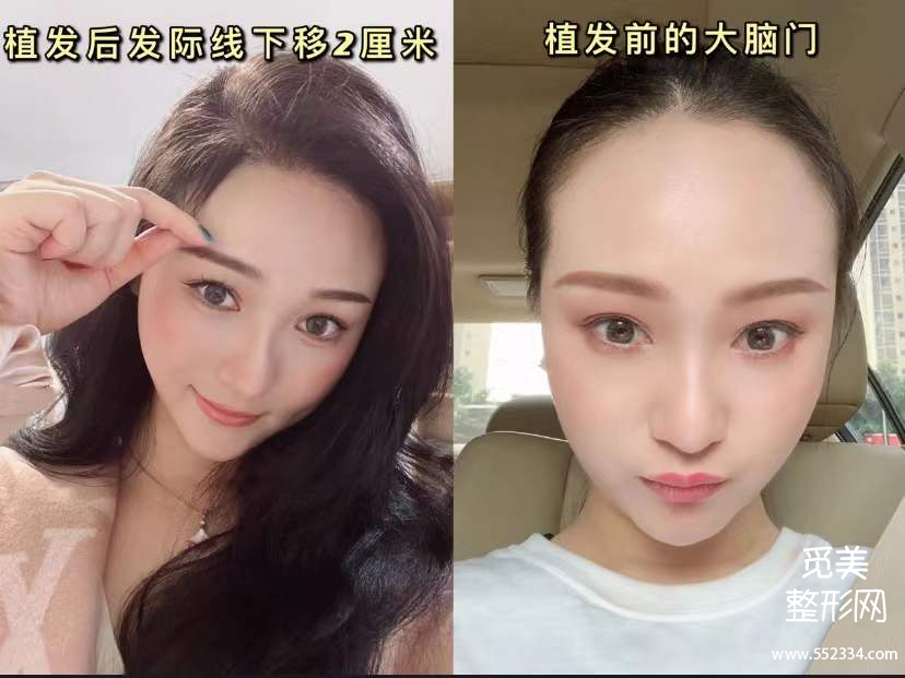 南京植发靠谱吗?有推荐的医生吗?真实案例反馈!