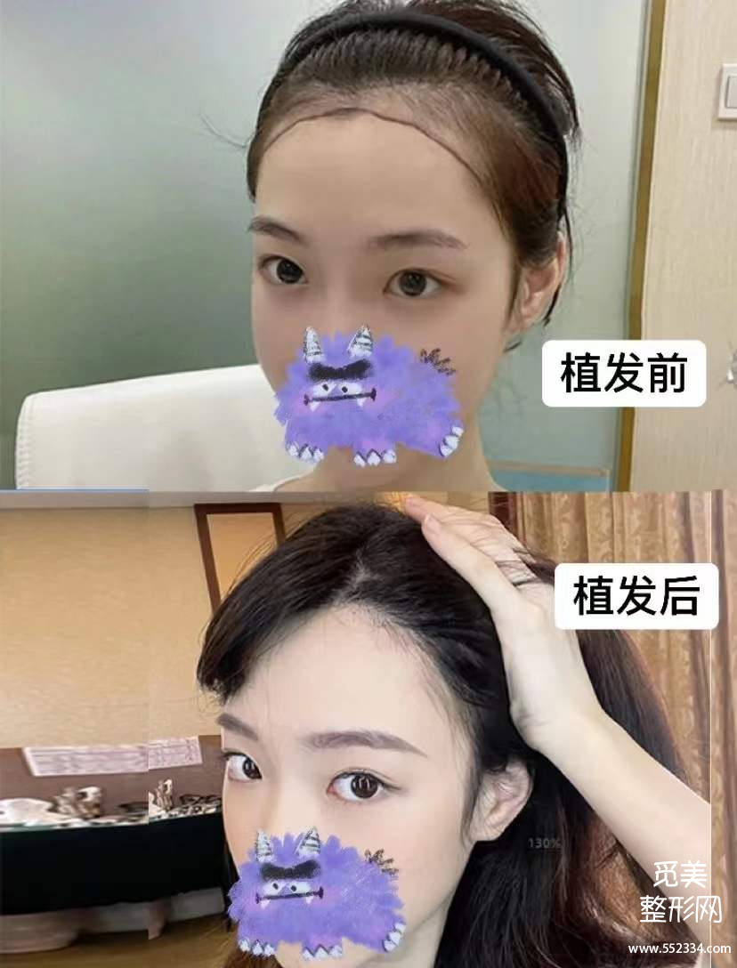 南京植发靠谱吗?有推荐的医生吗?真实案例反馈!