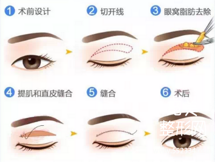 全切、韩式和埋线双眼皮到底哪种*果好,该怎么选择?价格贵不贵呢?