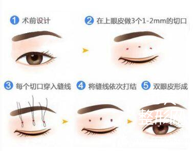 全切、韩式和埋线双眼皮到底哪种*果好,该怎么选择?价格贵不贵呢?