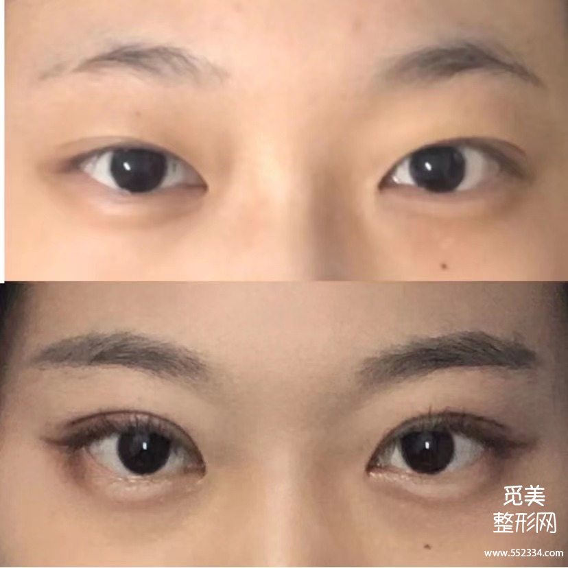 全切、韩式和埋线双眼皮到底哪种*果好,该怎么选择?价格贵不贵呢?