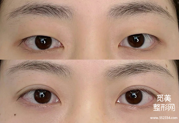 全切、韩式和埋线双眼皮到底哪种*果好,该怎么选择?价格贵不贵呢?