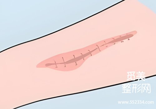 成都疤痕修复吕靖医生好吗?详细剖析了医生资料